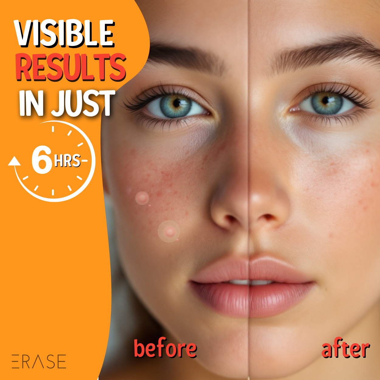 ERASE Acne Patches