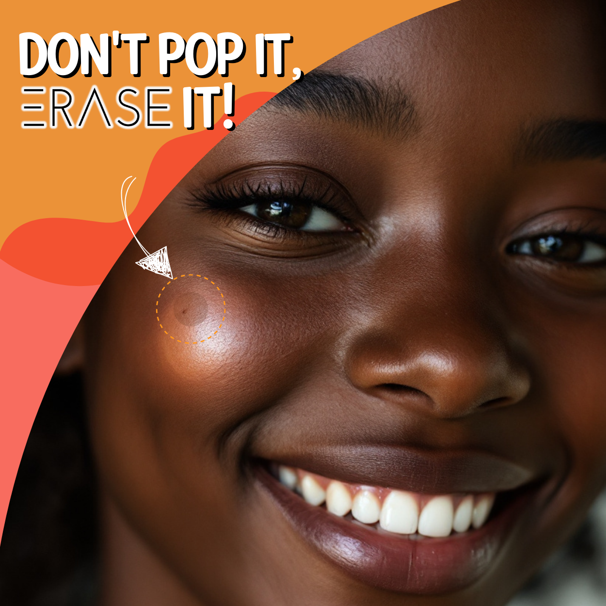 ERASE Acne Patches